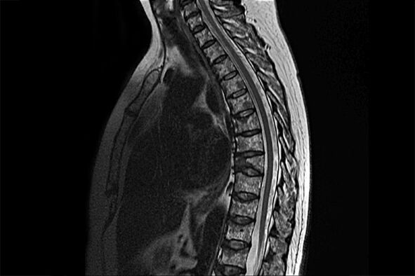 Manifestacións da osteocondrose torácica na imaxe da resonancia magnética
