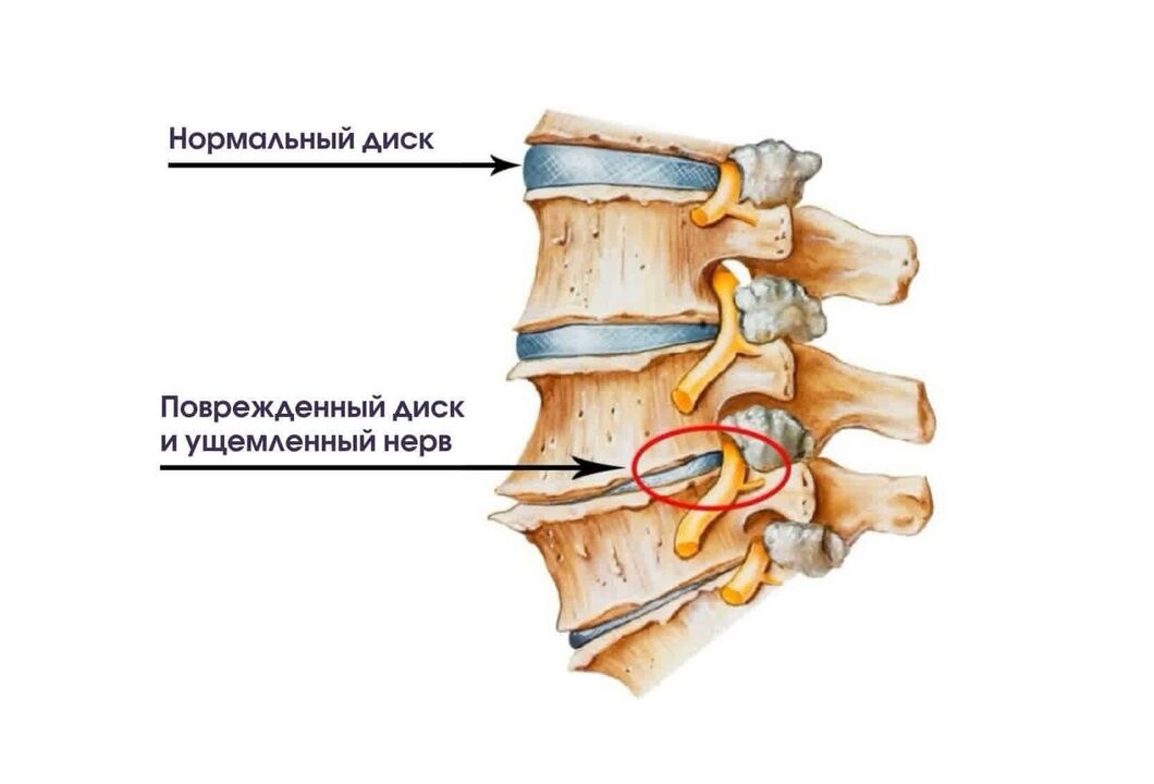 Síntomas dunha osteocondrose pescozo