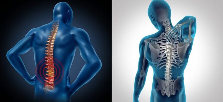 Inflamación na osteocondrose espinal