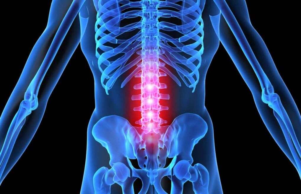 Osteocondrose da columna vertebral lumbar
