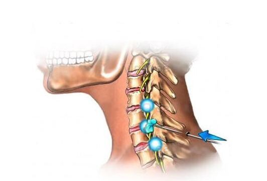 Tratamento da osteocondrose cervical